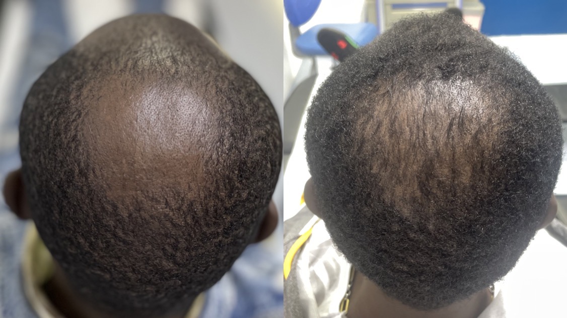 Programa Médico para Alopecia Androgénica